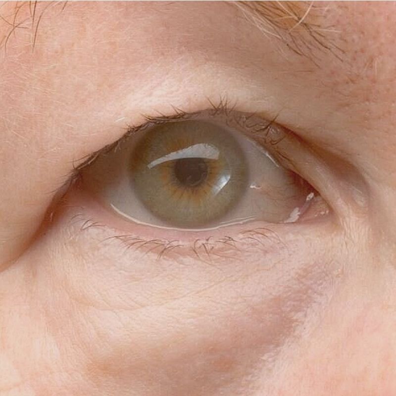 Eyelid Lift Tired Eyes
