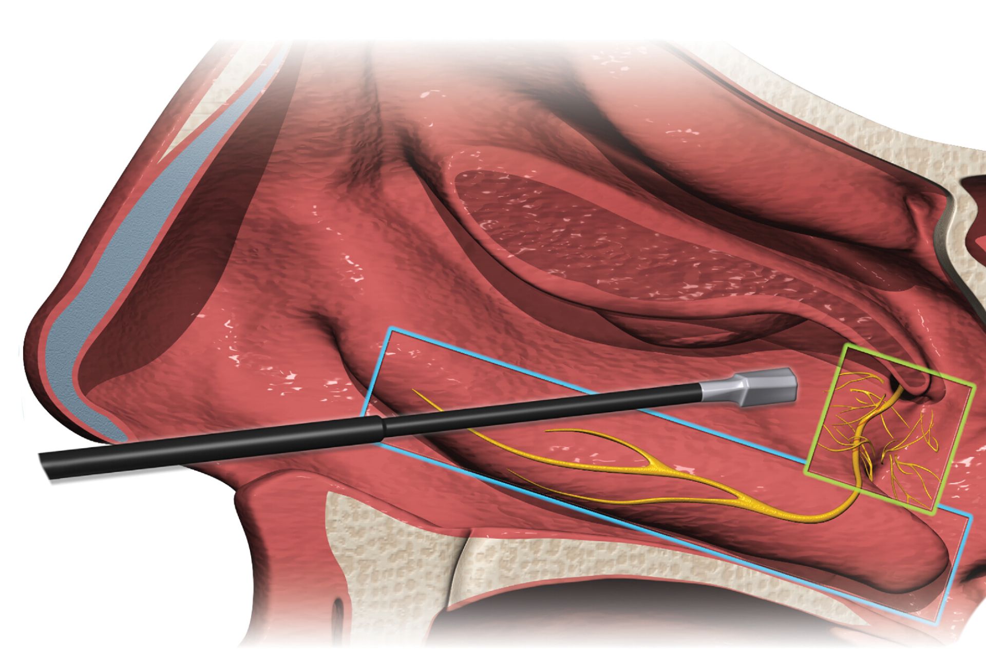 RhinAer&reg; treatment
