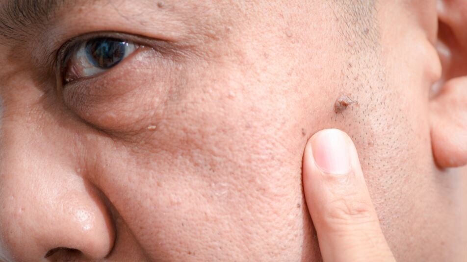 Skin+Lesion4