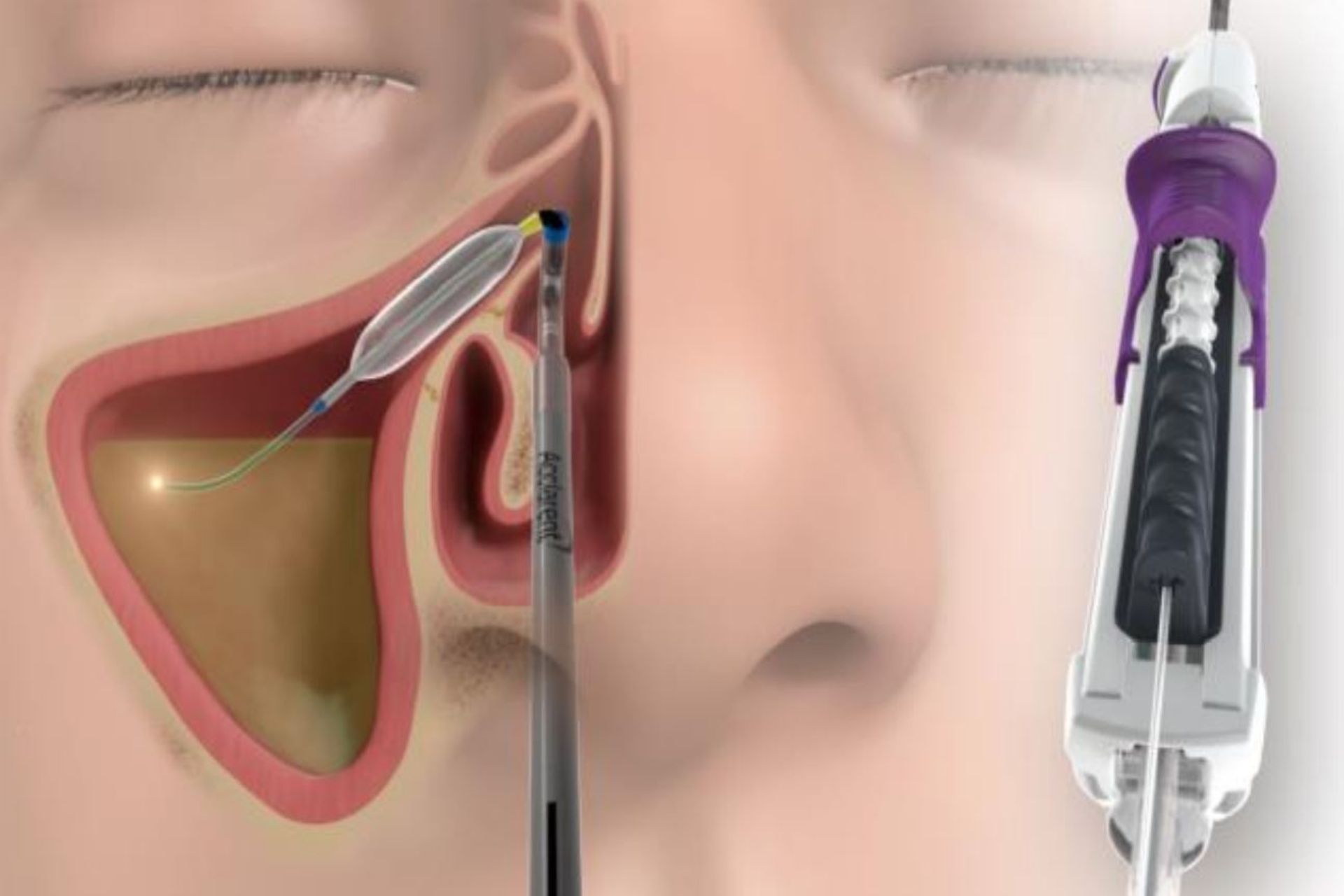 Balloon Sinuplasty Diagram