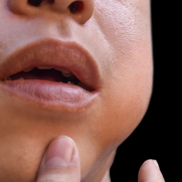 Salivary Gland disorder